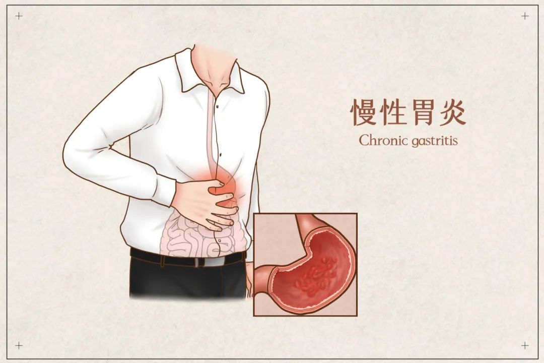 摄图网_401789711_慢性胃炎医疗插画(企业商用).jpg